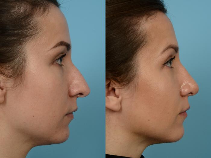 Before & After Rhinoplasty by Dr. Mustoe Case 927 Right Side View in Chicago, IL