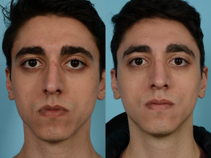 Before & After Rhinoplasty by Dr. Mustoe Case 935 Front View in Chicago, IL