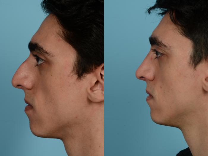 Before & After Rhinoplasty by Dr. Mustoe Case 935 Left Side View in Chicago, IL