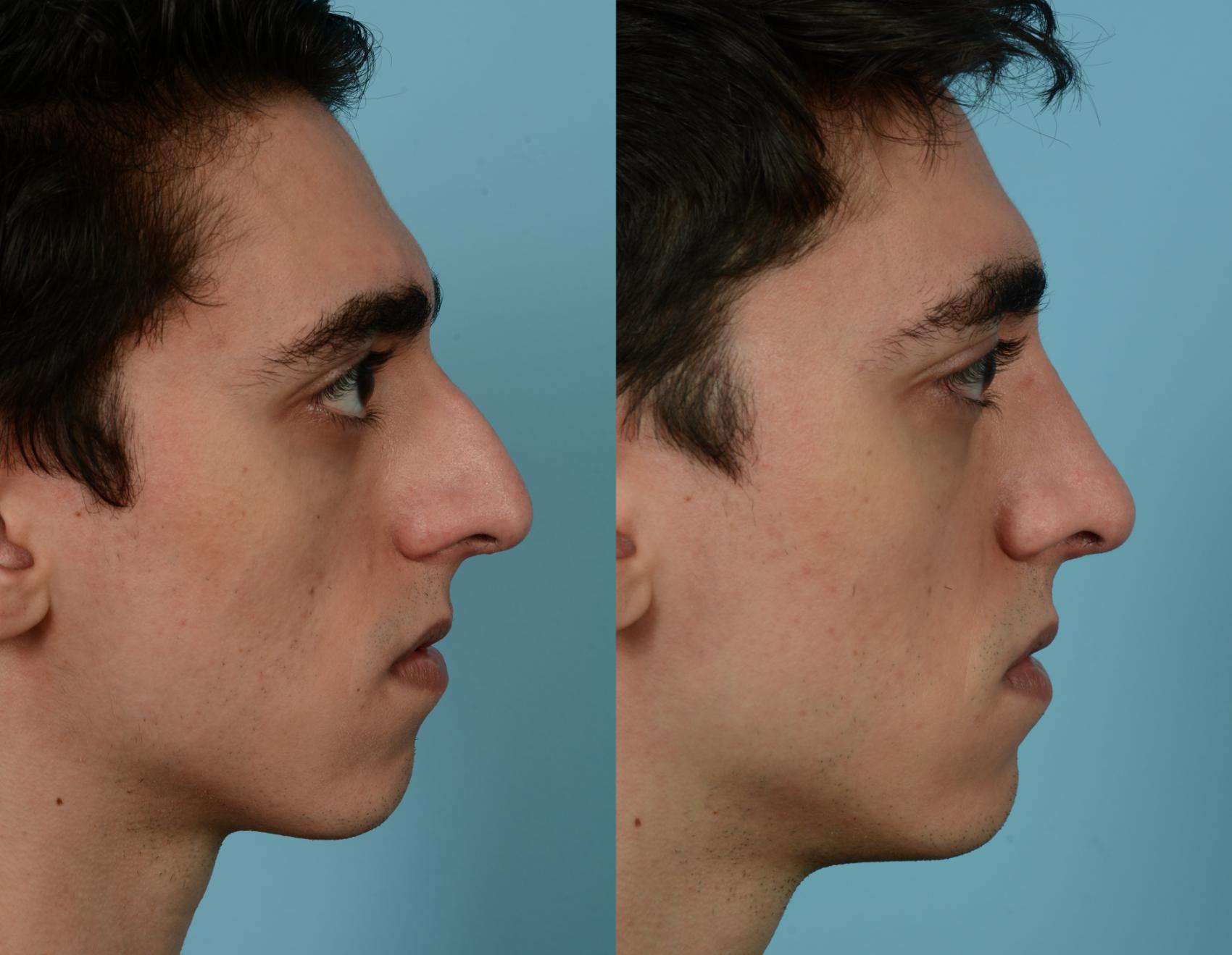 Before & After Rhinoplasty by Dr. Mustoe Case 935 Right Side View in Chicago, IL