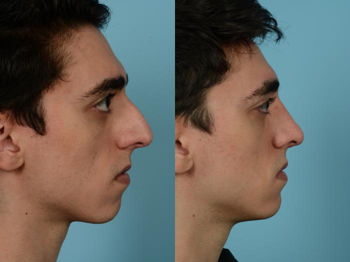 Before & After Rhinoplasty by Dr. Mustoe Case 935 Right Side View in Chicago, IL