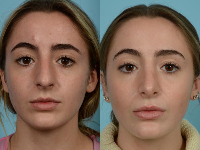 Before & After Rhinoplasty by Dr. Mustoe Case 936 Front View in Chicago, IL