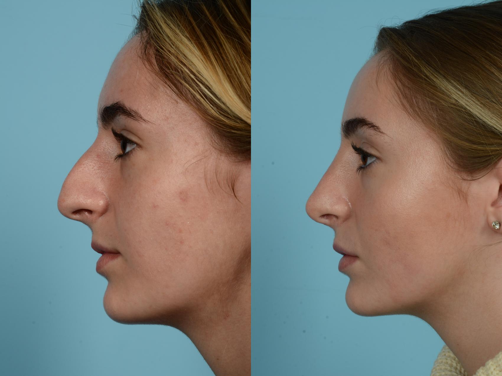 Before & After Rhinoplasty by Dr. Mustoe Case 936 Left Side View in Chicago, IL