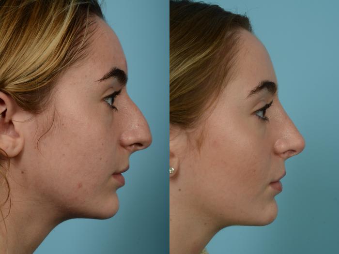 Before & After Rhinoplasty by Dr. Mustoe Case 936 Right Side View in Chicago, IL