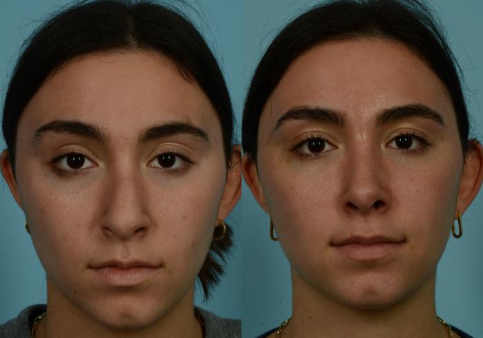 Before & After Rhinoplasty by Dr. Mustoe Case 944 Front View in Chicago, IL