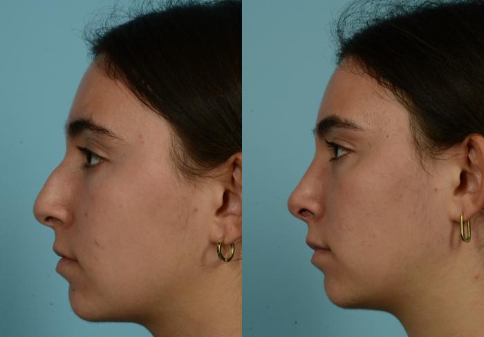 Before & After Rhinoplasty by Dr. Mustoe Case 944 Left Side View in Chicago, IL