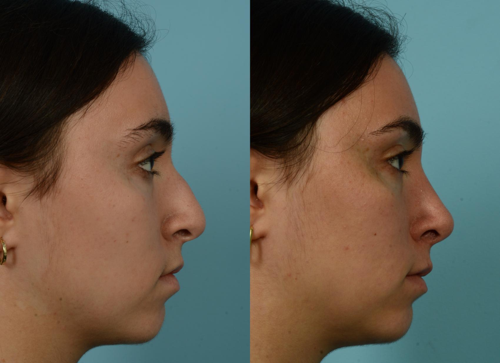 Before & After Rhinoplasty by Dr. Mustoe Case 944 Right Side View in Chicago, IL