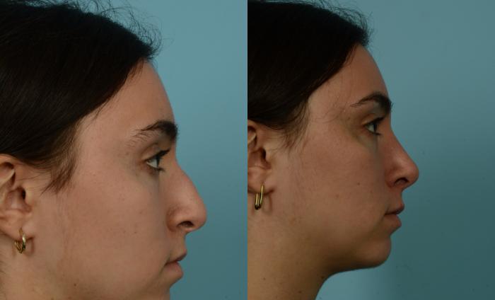 Before & After Rhinoplasty by Dr. Mustoe Case 944 Right Side View in Chicago, IL