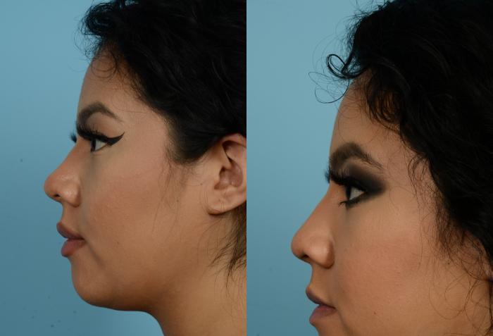 Before & After Rhinoplasty by Dr. Mustoe Case 945 Left Side View in Chicago, IL