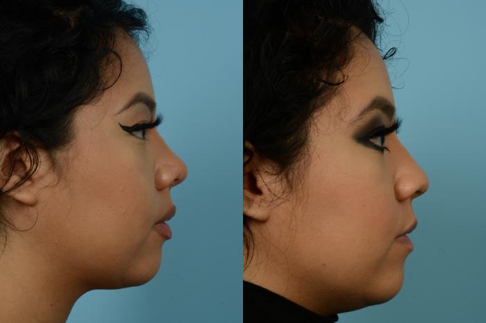 Before & After Rhinoplasty by Dr. Mustoe Case 945 Right Side View in Chicago, IL