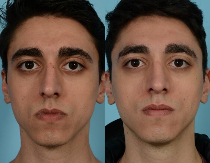 Before & After Rhinoplasty by Dr. Mustoe Case 946 Front View in Chicago, IL
