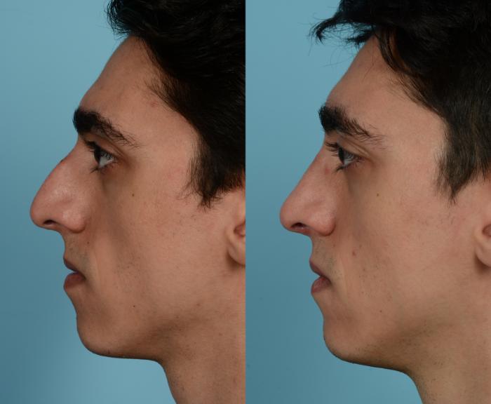 Before & After Rhinoplasty by Dr. Mustoe Case 946 Left Side View in Chicago, IL