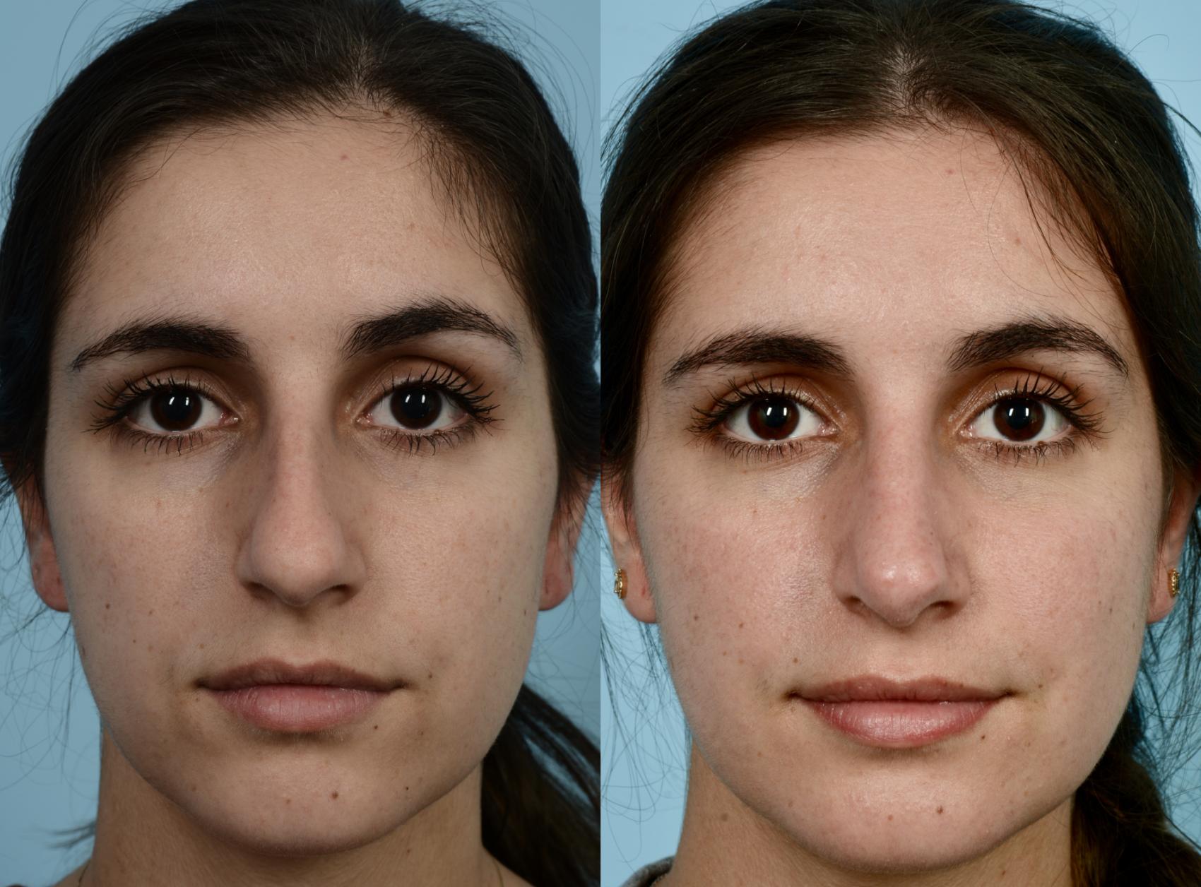 Before & After Rhinoplasty by Dr. Mustoe Case 947 Front View in Chicago, IL