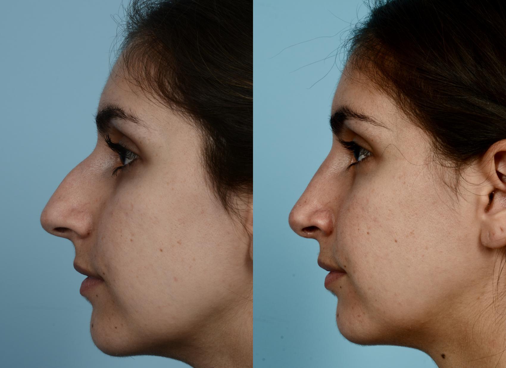 Before & After Rhinoplasty by Dr. Mustoe Case 947 Left Side View in Chicago, IL