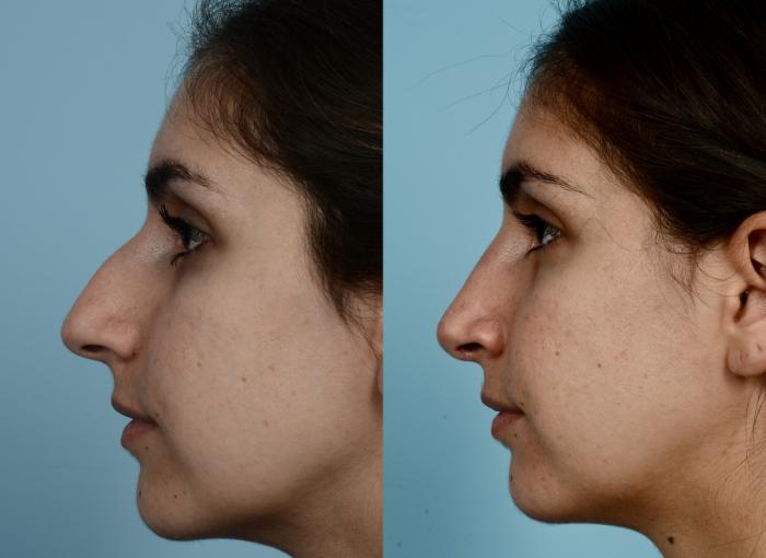 Before & After Rhinoplasty by Dr. Mustoe Case 947 Left Side View in Chicago, IL