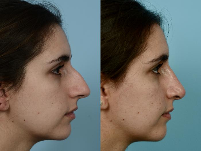 Before & After Rhinoplasty by Dr. Mustoe Case 947 Right Side View in Chicago, IL
