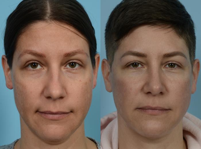 Before & After Rhinoplasty by Dr. Mustoe Case 949 Front View in Chicago, IL