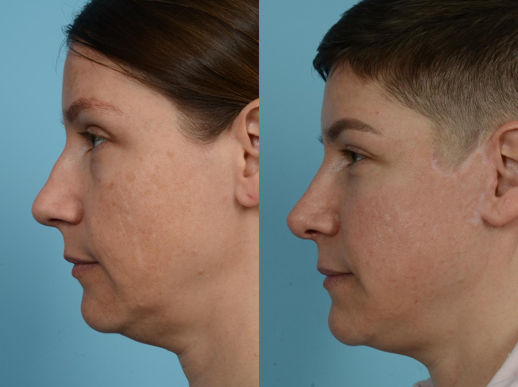 Before & After Rhinoplasty by Dr. Mustoe Case 949 Left Side View in Chicago, IL
