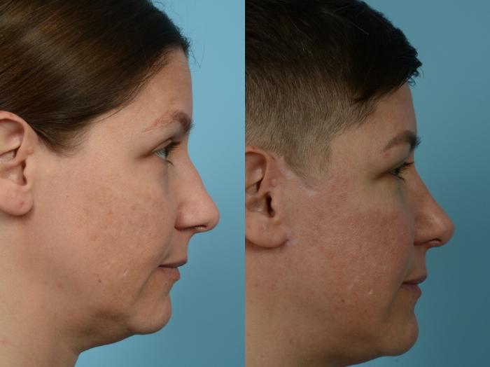 Before & After Rhinoplasty by Dr. Mustoe Case 949 Right Side View in Chicago, IL