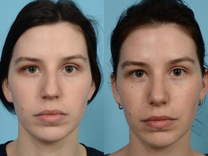 Before & After Rhinoplasty by Dr. Mustoe Case 951 Front View in Chicago, IL
