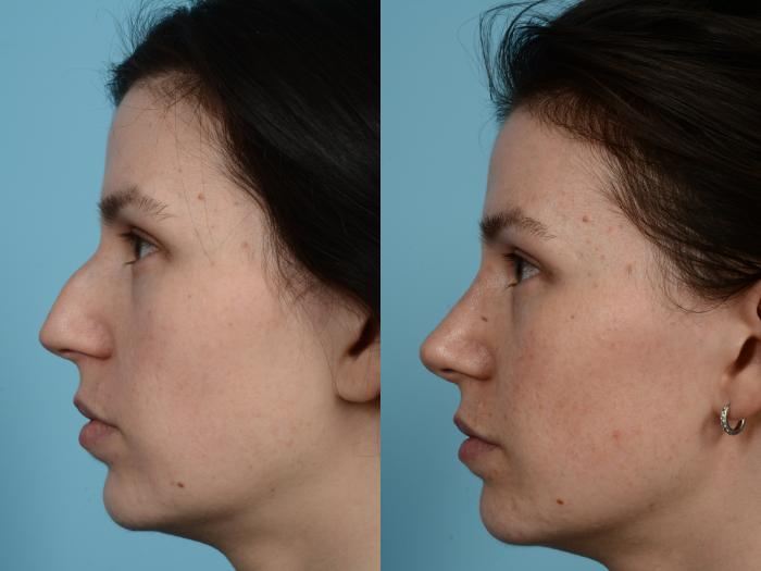 Before & After Rhinoplasty by Dr. Mustoe Case 951 Left Side View in Chicago, IL