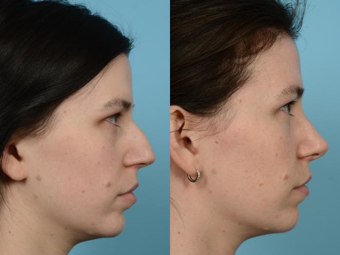 Before & After Rhinoplasty by Dr. Mustoe Case 951 Right Side View in Chicago, IL