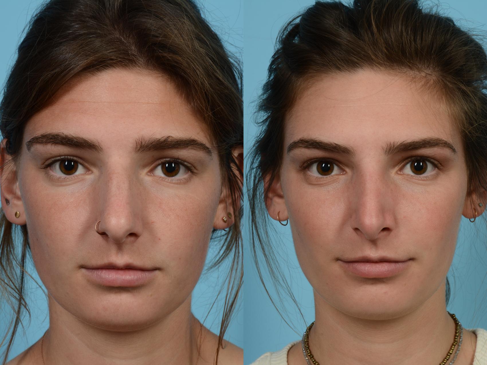 Before & After Rhinoplasty by Dr. Mustoe Case 952 Front View in Chicago, IL