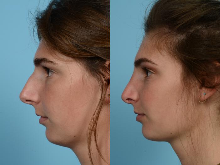 Before & After Rhinoplasty by Dr. Mustoe Case 952 Left Side View in Chicago, IL