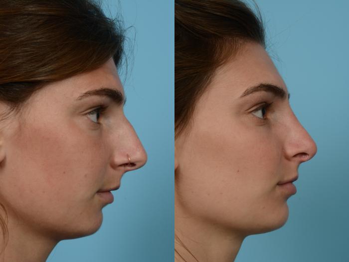 Before & After Rhinoplasty by Dr. Mustoe Case 952 Right Side View in Chicago, IL