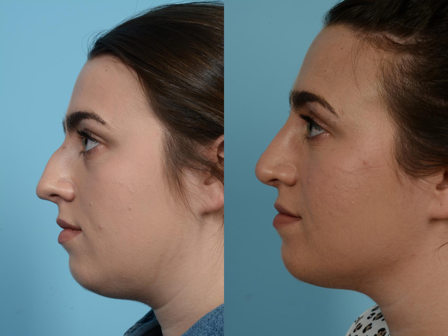 Before & After Rhinoplasty by Dr. Mustoe Case 954 Left Side View in Chicago, IL