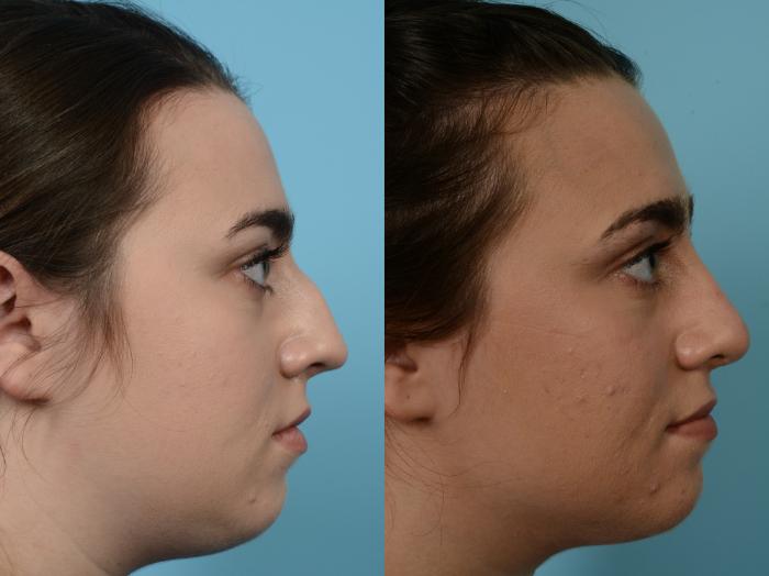 Before & After Rhinoplasty by Dr. Mustoe Case 954 Right Side View in Chicago, IL