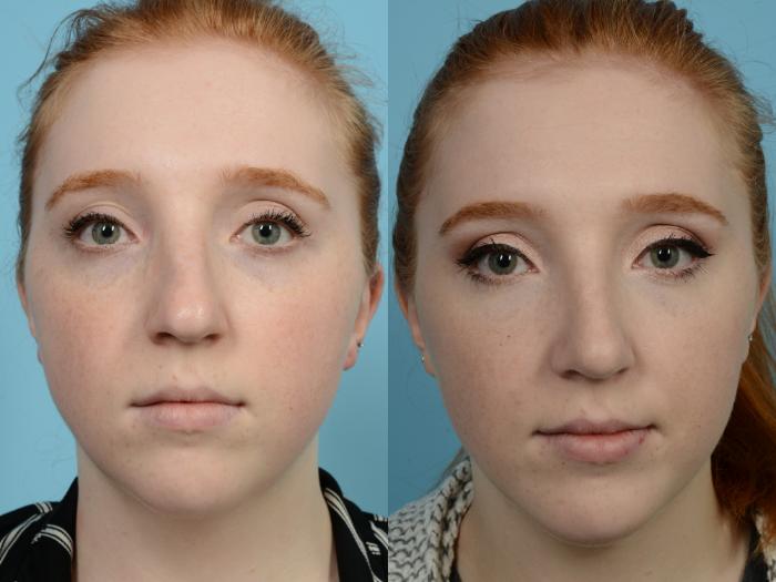 Before & After Rhinoplasty by Dr. Mustoe Case 955 Front View in Chicago, IL