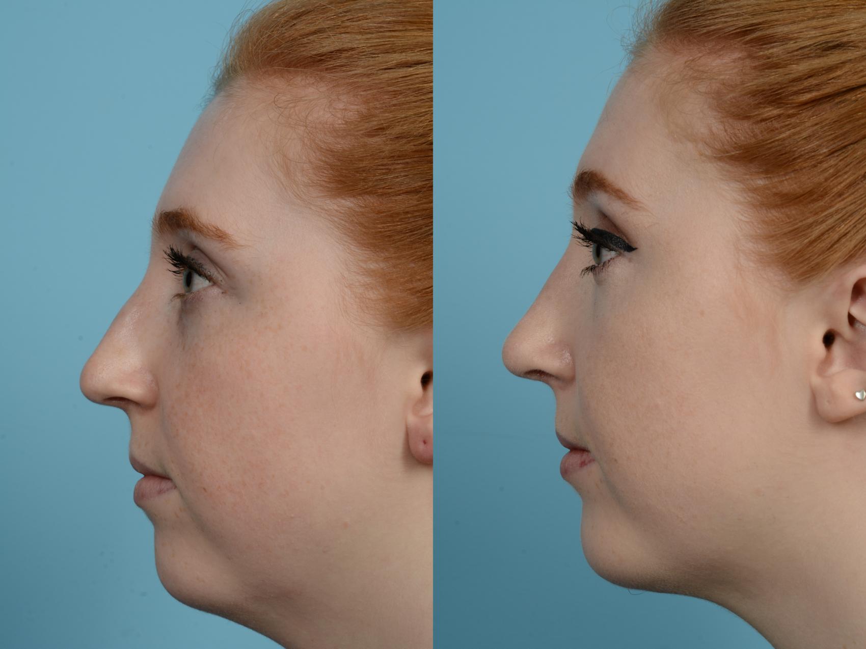Before & After Rhinoplasty by Dr. Mustoe Case 955 Left Side View in Chicago, IL