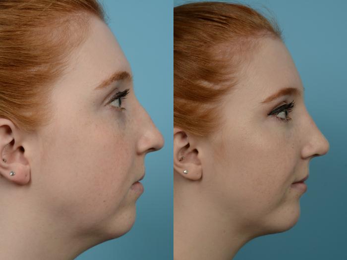 Before & After Rhinoplasty by Dr. Mustoe Case 955 Right Side View in Chicago, IL