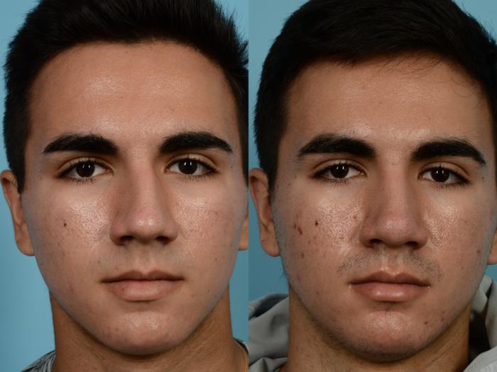Before & After Rhinoplasty by Dr. Mustoe Case 956 Front View in Chicago, IL