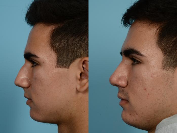 Before & After Rhinoplasty by Dr. Mustoe Case 956 Left Side View in Chicago, IL
