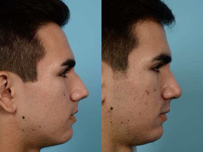 Before & After Rhinoplasty by Dr. Mustoe Case 956 Right Side View in Chicago, IL