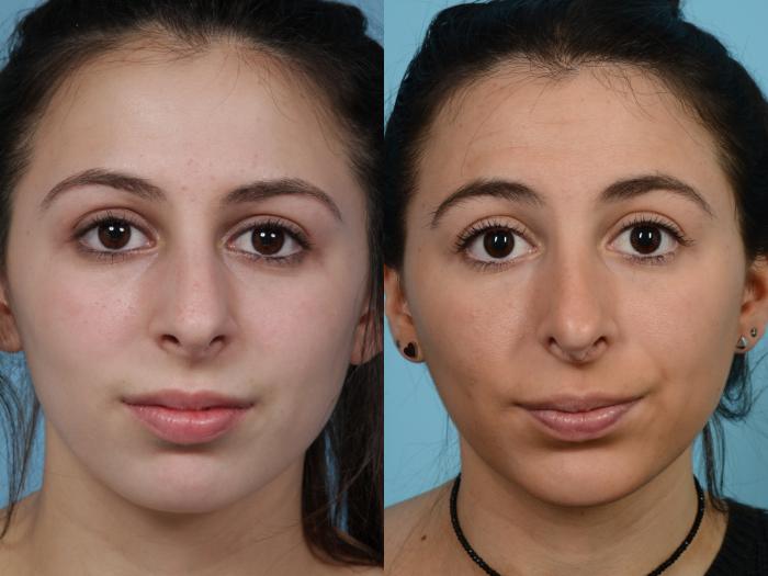 Before & After Rhinoplasty by Dr. Mustoe Case 959 Front View in Chicago, IL