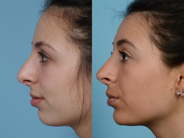 Before & After Rhinoplasty by Dr. Mustoe Case 959 Left Side View in Chicago, IL