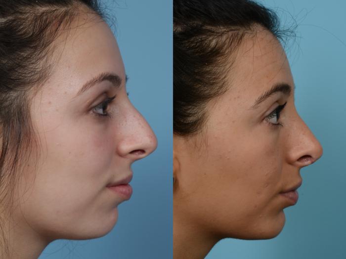 Before & After Rhinoplasty by Dr. Mustoe Case 959 Right Side View in Chicago, IL