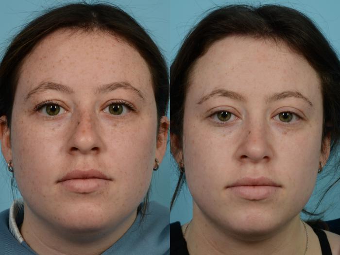 Before & After Rhinoplasty by Dr. Mustoe Case 962 Front View in Chicago, IL