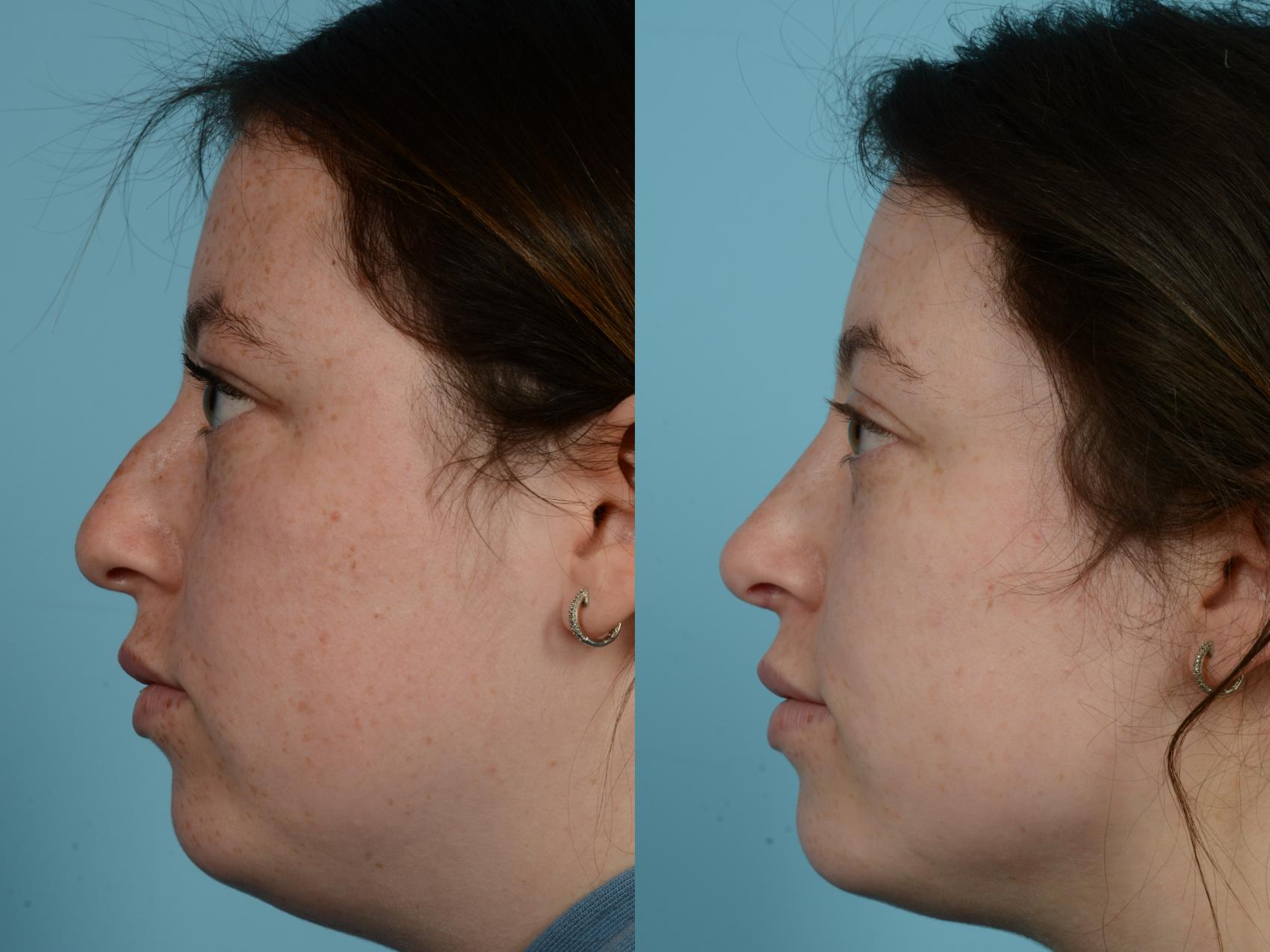 Before & After Rhinoplasty by Dr. Mustoe Case 962 Left Side View in Chicago, IL