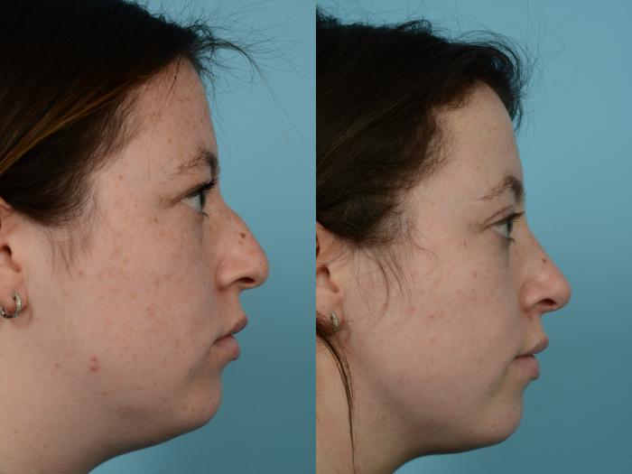 Before & After Rhinoplasty by Dr. Mustoe Case 962 Right Side View in Chicago, IL