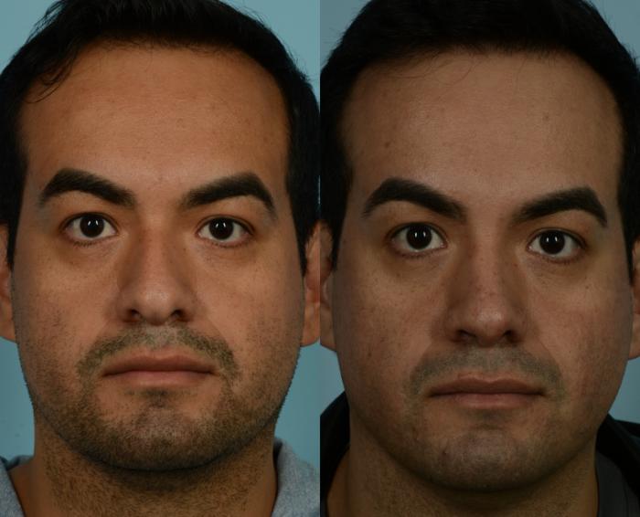 Before & After Rhinoplasty by Dr. Mustoe Case 964 Front View in Chicago, IL