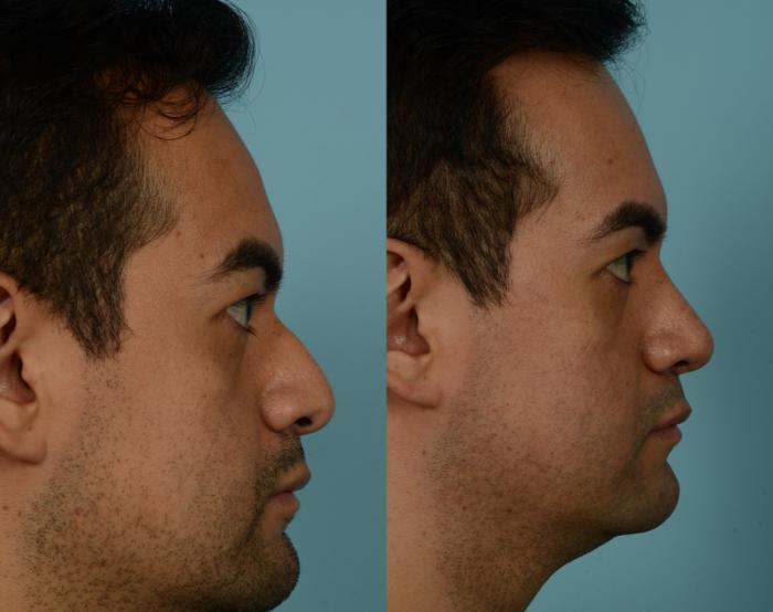 Before & After Rhinoplasty by Dr. Mustoe Case 964 Right Side View in Chicago, IL