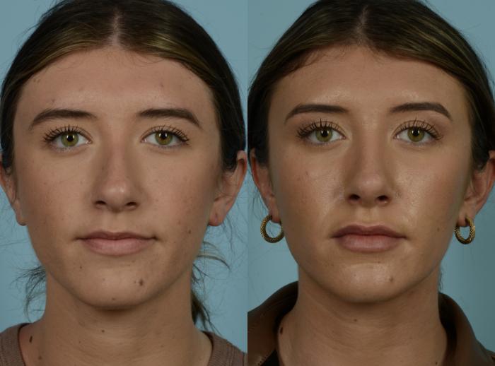 Before & After Rhinoplasty by Dr. Mustoe Case 965 Front View in Chicago, IL