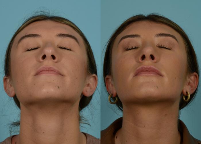 Before & After Rhinoplasty by Dr. Mustoe Case 965 Front Tilt View in Chicago, IL