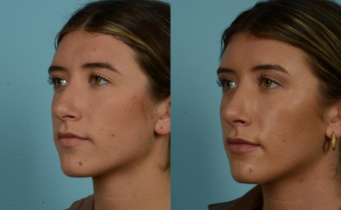 Before & After Rhinoplasty by Dr. Mustoe Case 965 Left Oblique View in Chicago, IL