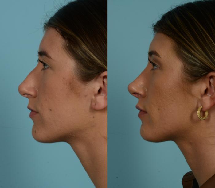 Before & After Rhinoplasty by Dr. Mustoe Case 965 Left Side View in Chicago, IL