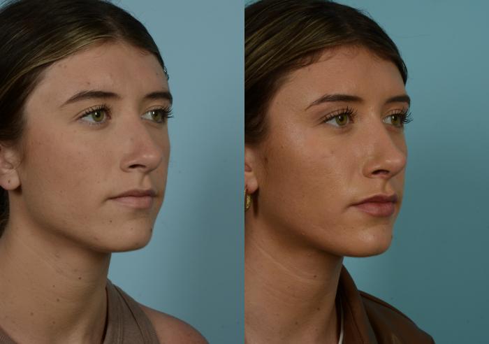 Before & After Rhinoplasty by Dr. Mustoe Case 965 Right Oblique View in Chicago, IL